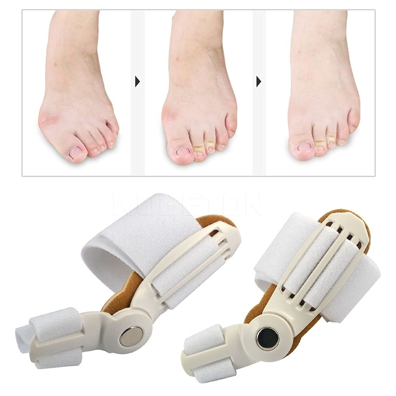 ToeAligner™ - Verlichting van hallux valgus in Seconden!