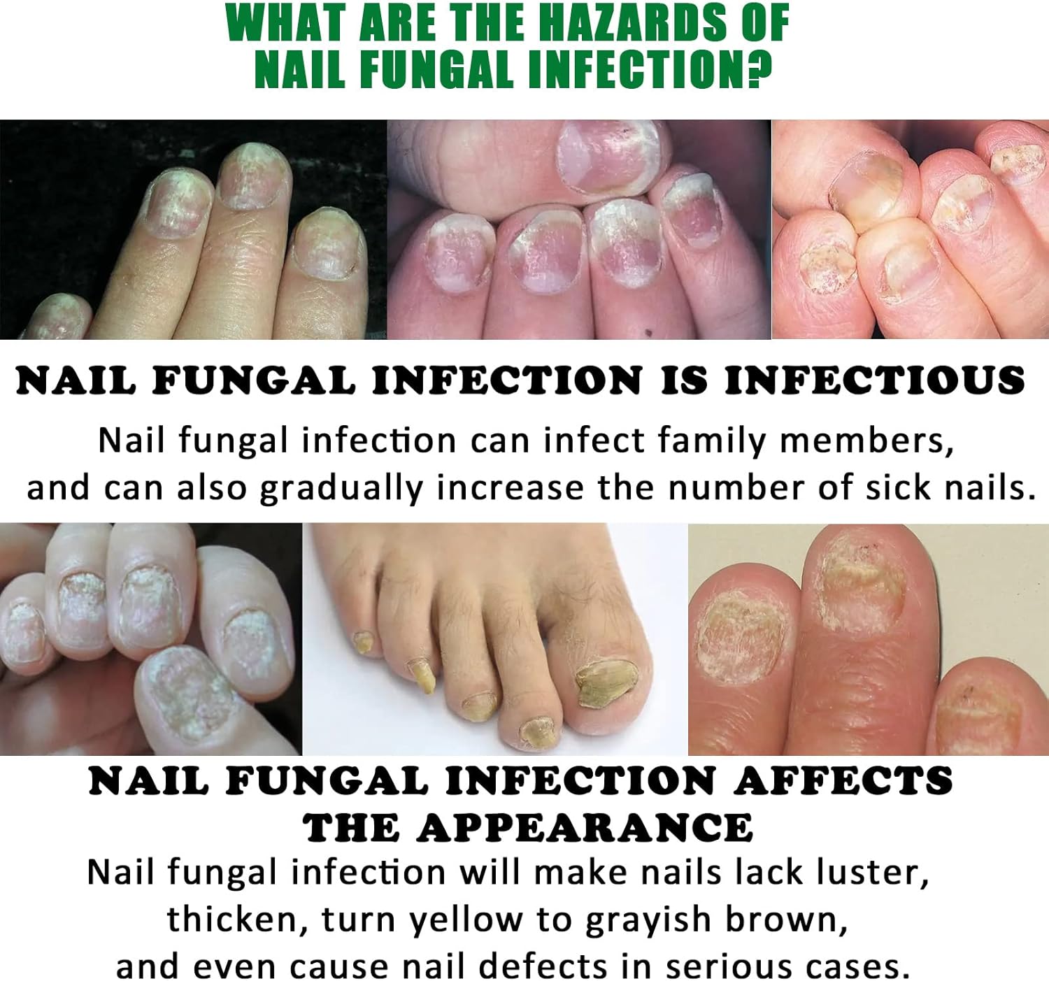 FungiGone™ - Voor gezonde, mooie nagels zonder schimmelinfecties