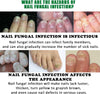 FungiGone™ - Voor gezonde, mooie nagels zonder schimmelinfecties