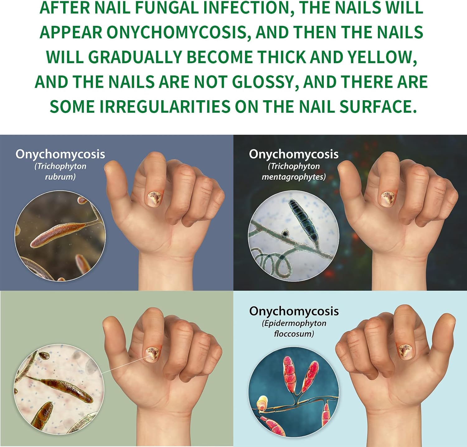 FungiGone™ - Voor gezonde, mooie nagels zonder schimmelinfecties